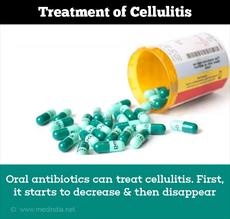 Best Topical Antibiotic For Cellulitis at Helen Fisk blog