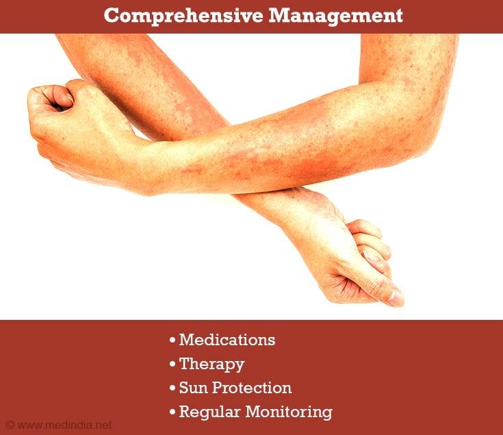 Treatments for Dermatomyositis Treatments for Dermatomyositis