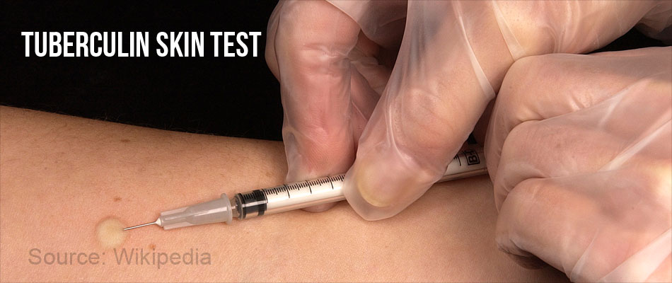 Tuberculin Skin Test Tuberculin Skin Test