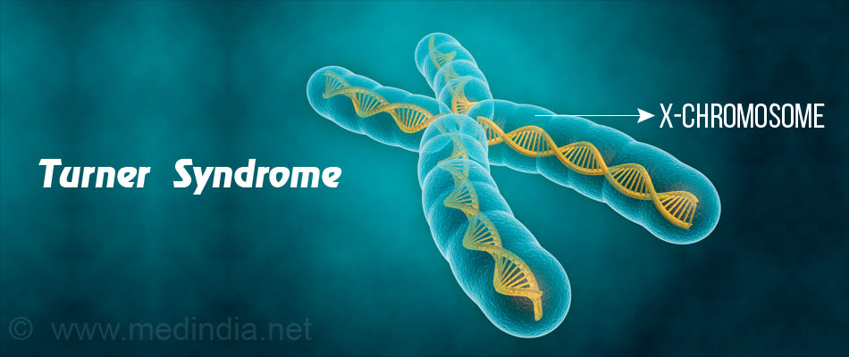 what causes turner syndrome