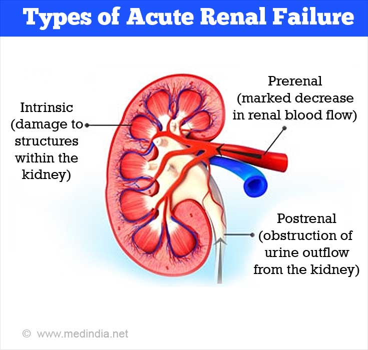 What Causes Acute Renal Failure In Humans