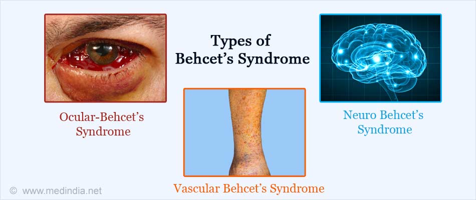 Behcet's Syndrome | Behcet's Disease - Causes, Symptoms, Diagnosis ...