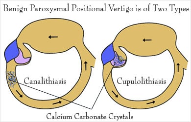 Types of Benign Paroxysmal Positional Vertigo Types of Benign Paroxysmal Positional Vertigo
