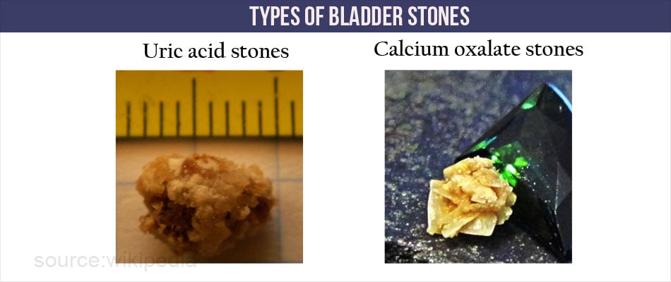 Bladder Stones | Vesical Calculi - Causes, Symptoms, Diagnosis ...