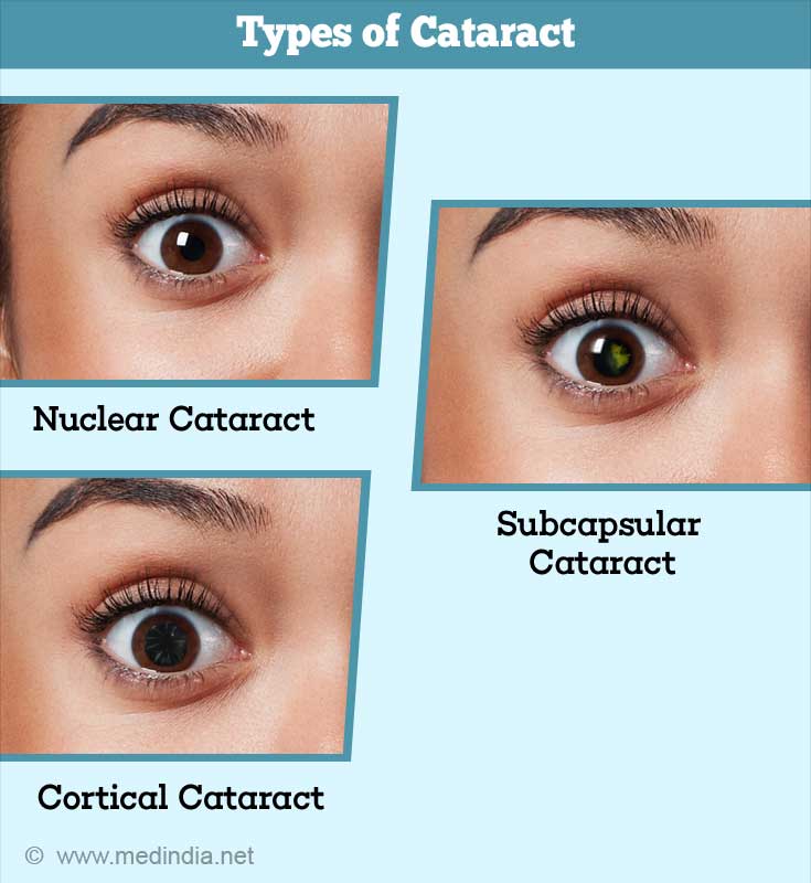 Cataract Causes Symptoms Diagnosis Treatment Prevention