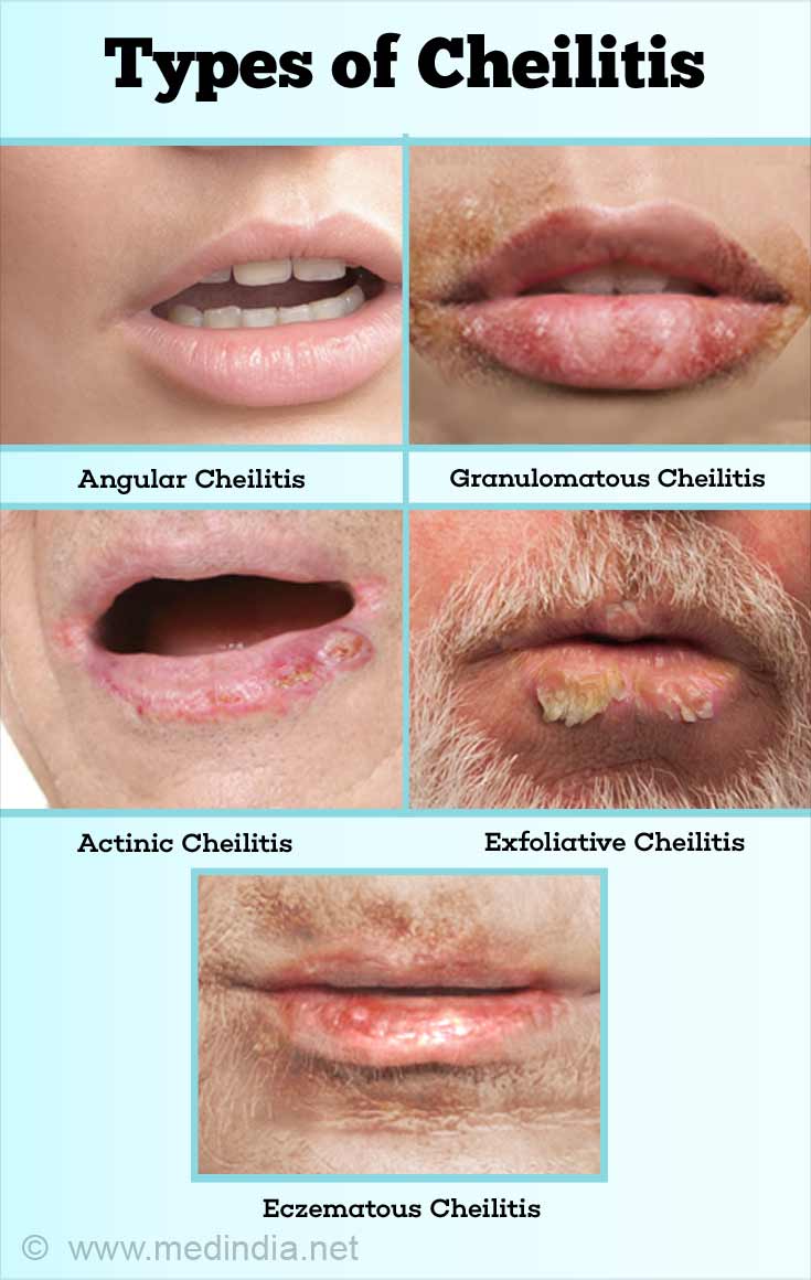 Cheilitis Causes Symptoms Diagnosis Treatment