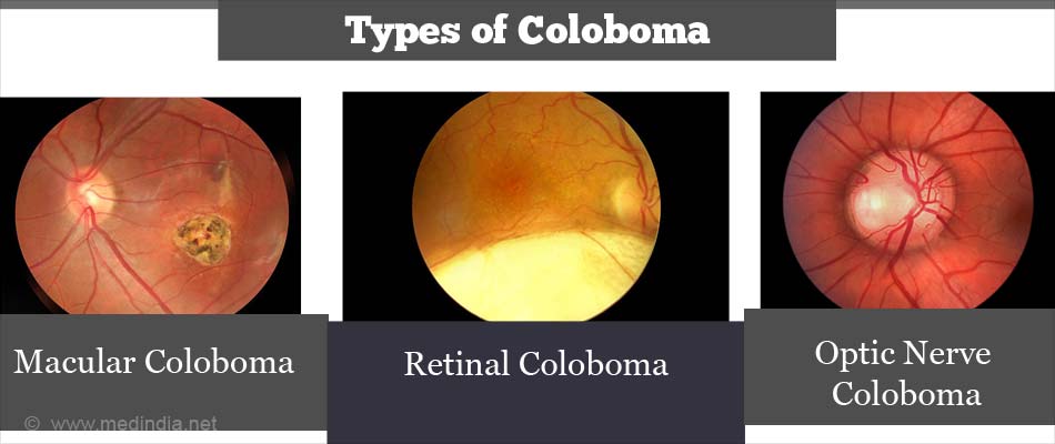 Coloboma - Causes, Symptoms, Diagnosis, Treatment & Prevention