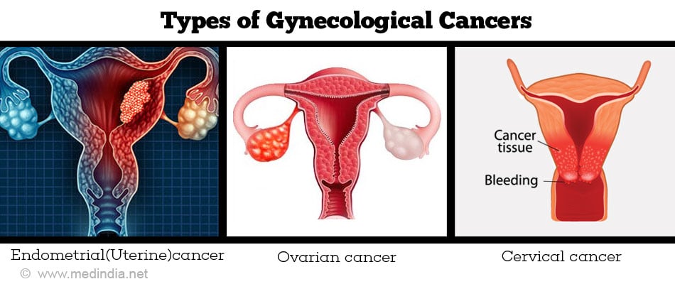 Gynae Cancers video: a Brief Explanation