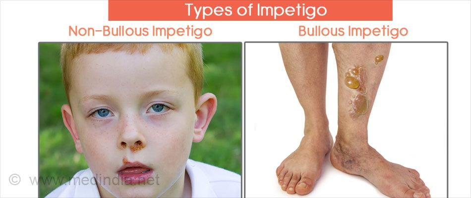 impetigo-symptoms-causes-complications-diagnosis-treatment