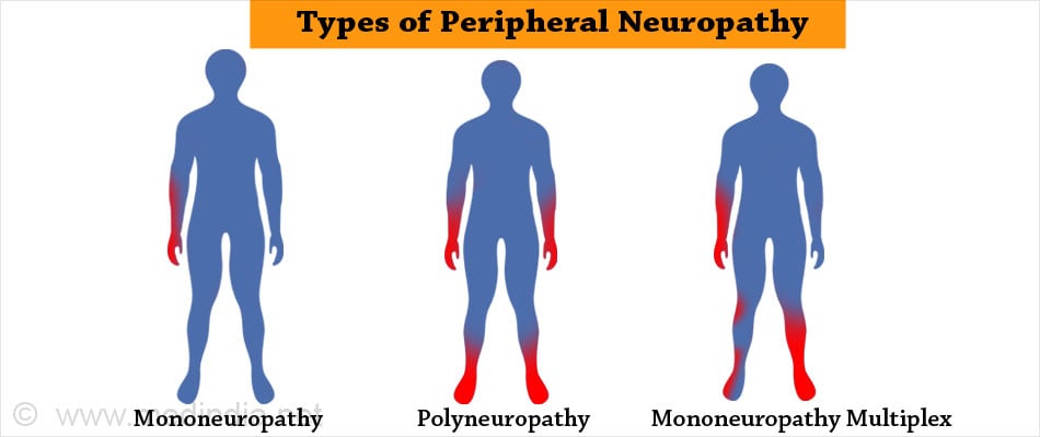 Peripheral Neuropathy - Types, Causes, Symptoms, Diagnosis ...