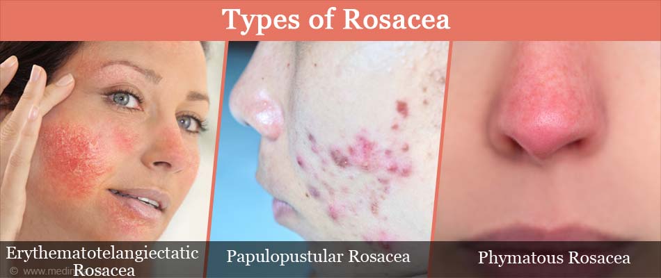 Rosacea Causes Types Symptoms Diagnosis Treatment
