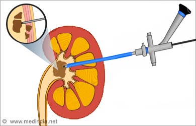 Treatment to Prevent Kidney Stones: Ureteroscopy Treatment to Prevent Kidney Stones: Ureteroscopy
