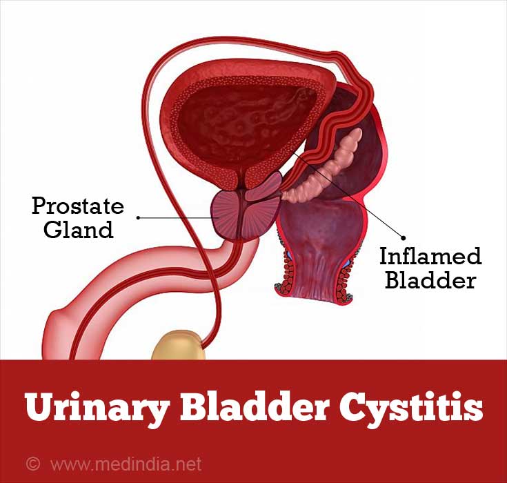 Possible Side Effects of External Beam Radiation Therapy Include Urinary Bladder Cystisis Possible Side Effects of External Beam Radiation Therapy Include Urinary Bladder Cystisis