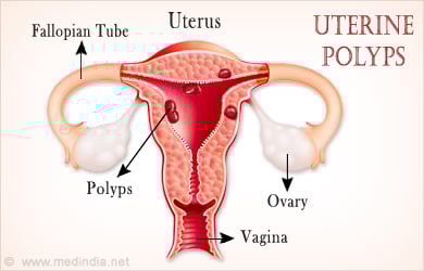 Uterine Polyps Uterine Polyps