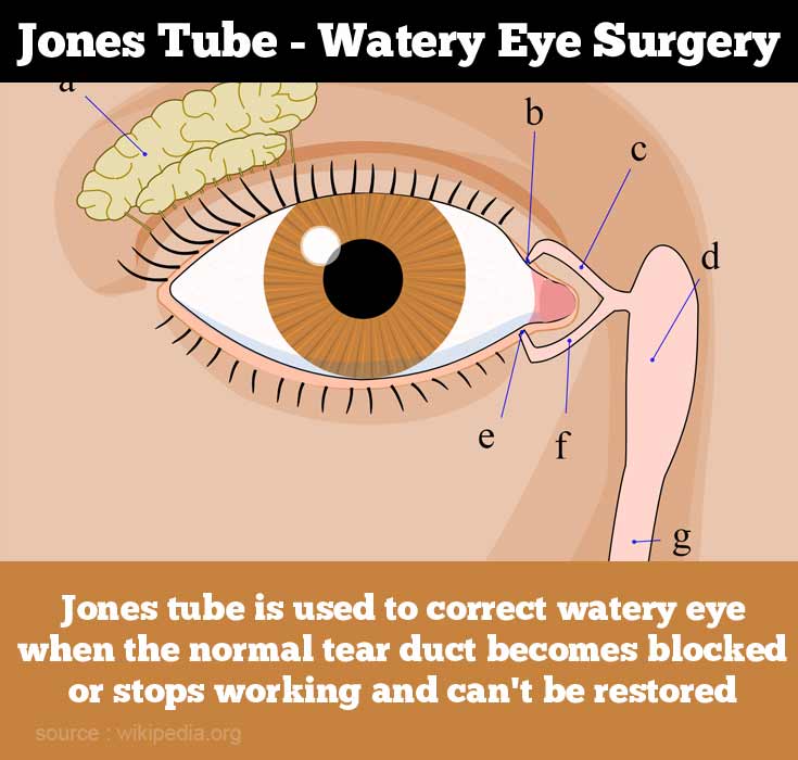 Watery Eyes: Causes & treatment