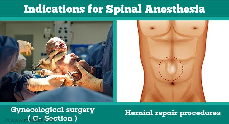 Another Word For Spinal Anesthesia