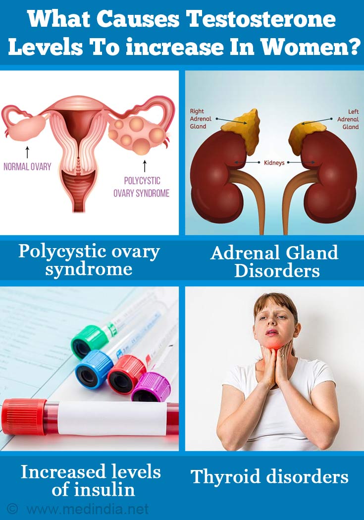 High Testosterone Level In Women Hyperandrogenism Causes Symptoms Complications Diagnosis