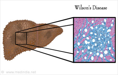 Wilsons Disease and Acute Liver Failure Wilsons Disease and Acute Liver Failure
