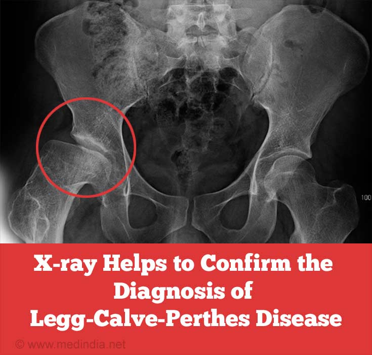 Legg Calve Perthes Disease Childhood Bone Disorder