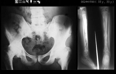 X-RAY Osteomyelitis X-RAY Osteomyelitis