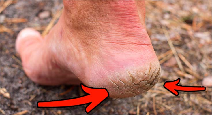 Feets Foot Peel Mask