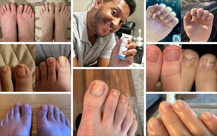 healio-nail-fungus-treatment