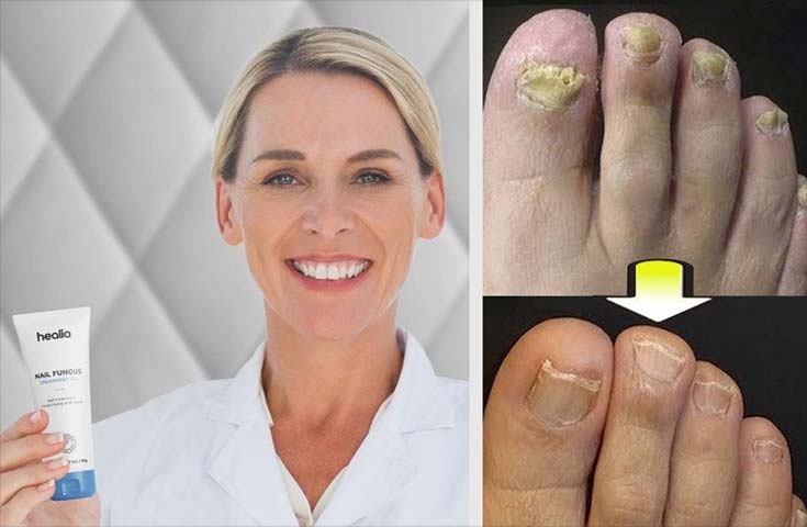 healio-nail-fungus-treatment