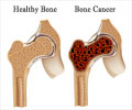 Quiz on Bone Cancer