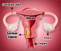 Quiz on Cervical Cancer