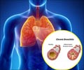 Quiz on Chronic Obstructive Pulmonary Disease (COPD)