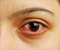 Quiz on Eye Disorders (Advanced)