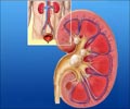 Quiz on Kidney Stones