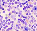 Quiz on Leukemia