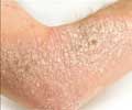 Quiz on Rash