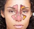 Quiz on Sinusitis