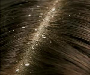 9 Diy Remedies for Dandruff-Free Hair