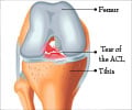 Anterior Cruciate Ligament (ACL) Reconstruction Surgery