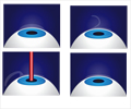 LASIK Eye Surgery - Surgical Procedure