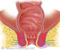 Piles / Hemorrhoids - Surgical options