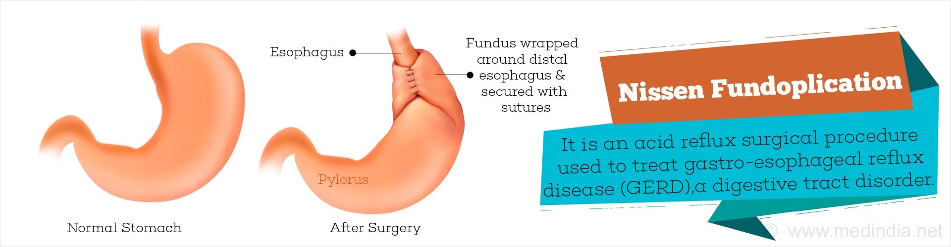 Nissen fundoplication Indications, Types & Risks