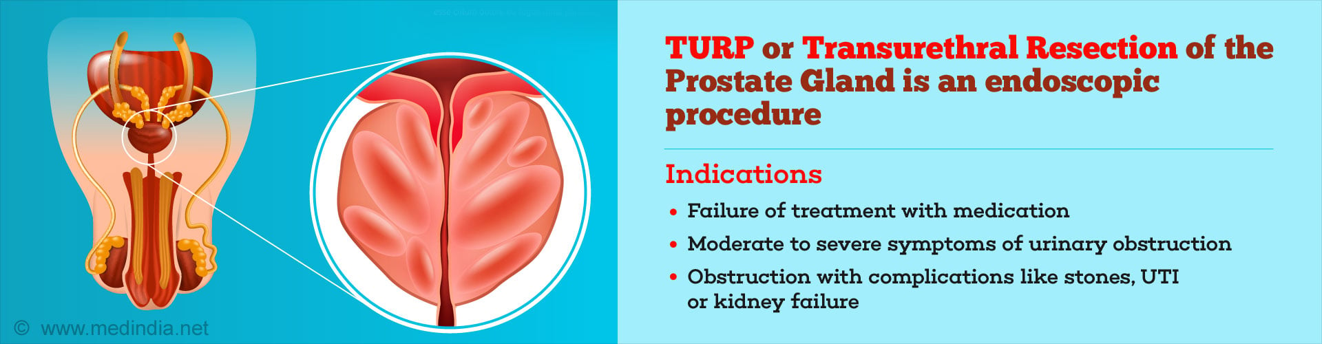 Transurethral Resection Of Prostate Turp For Prostate Enlargement 0314