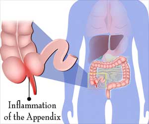 About Appendectomy