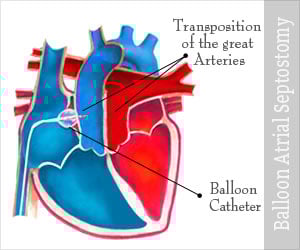 Balloon Atrial Septostomy - Conditions, Procedures, Modifications, Complications