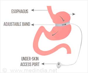 Bariatric Surgery or Weight Loss Surgery – Types, Complications and Results