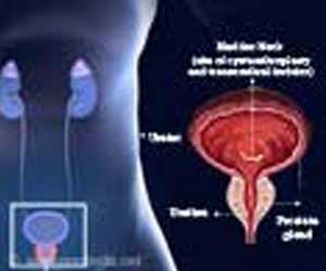 Bladder Neck Incision - Indications, Types and Complications