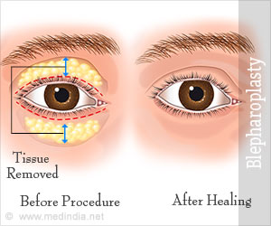 Blepharoplasty - Preparations, Precautions, Complications