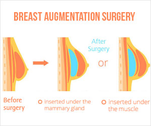 Breast Augmentation Surgery - Types, Indications, Surgical Procedure, Complications