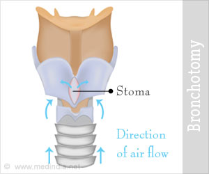 Bronchotomy | Surgical Airway Management - Complications, Precautions
