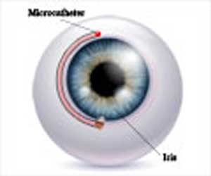 Canaloplasty - Indications, Preparation, Procedure, Recovery & Complications