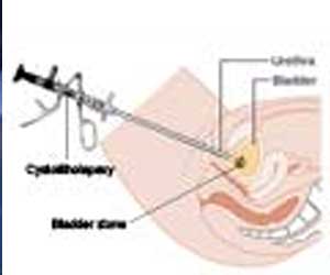Bladder Stones Treatment: Cystolitholapaxy